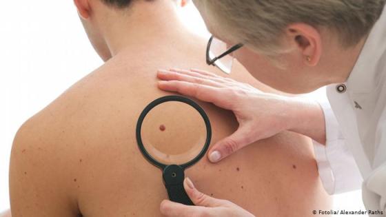 دراسة جديدة.. عقاقير تحمي من الاصابة بسرطان الجلد