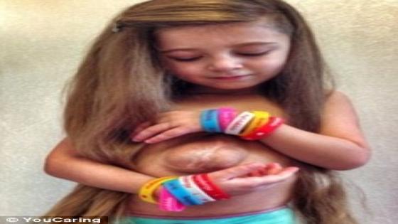 طفلة روسية تعيش بقلب وأمعاء خارجين عن جسدها